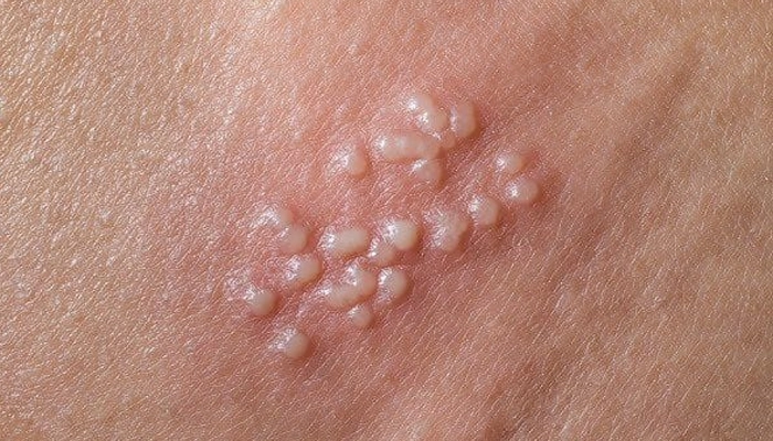 Mụn Rộp Sinh Dục Là Gì? Nguyên Nhân, Triệu Chứng Và Cách Điều Trị Hiệu Quả