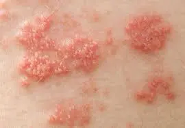 Zona thần kinh: Triệu chứng, nguyên nhân và cách phòng ngừa