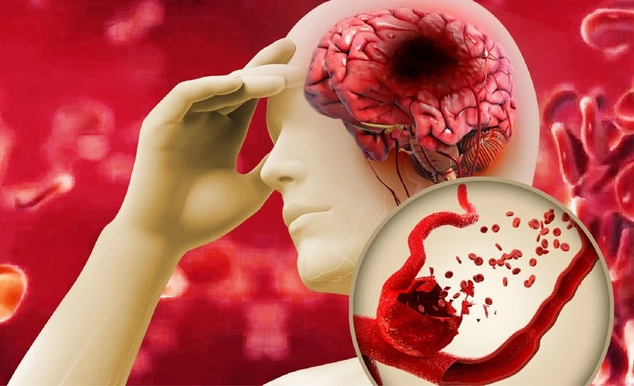 Mỡ máu tăng cao – 'Sát thủ' gây đột quỵ não