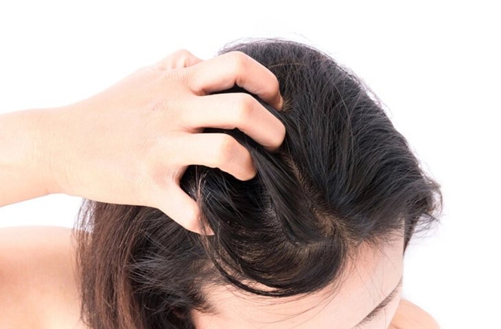 Bệnh nấm da đầu - nguyên nhân, biểu hiện và cách điều trị