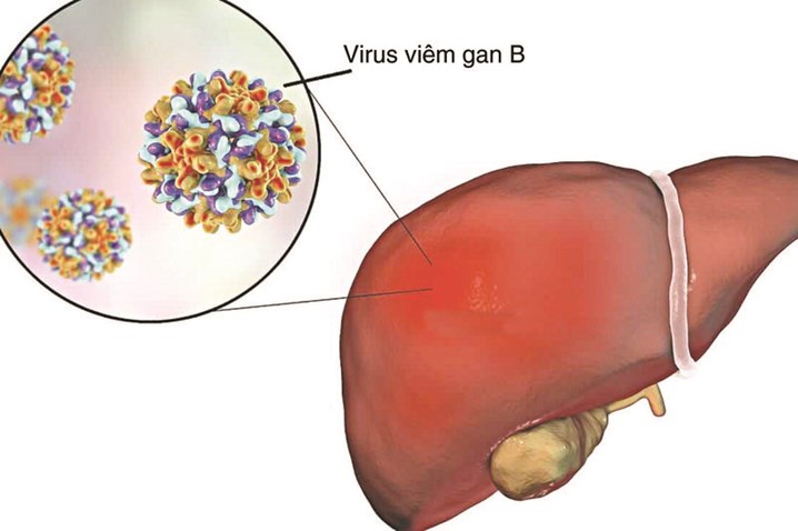 Làm gì khi bị viêm gan b?