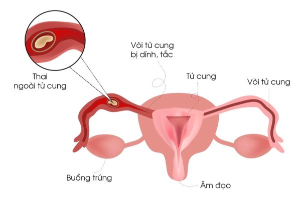 Mang thai ngoài tử cung: nguy hiểm và biện pháp phòng ngừa