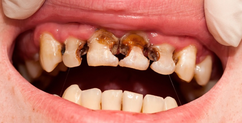 Con sâu răng dưới kính hiển vi có thật không? Sự thật về nguyên nhân gây sâu răng ai cũng nên biết