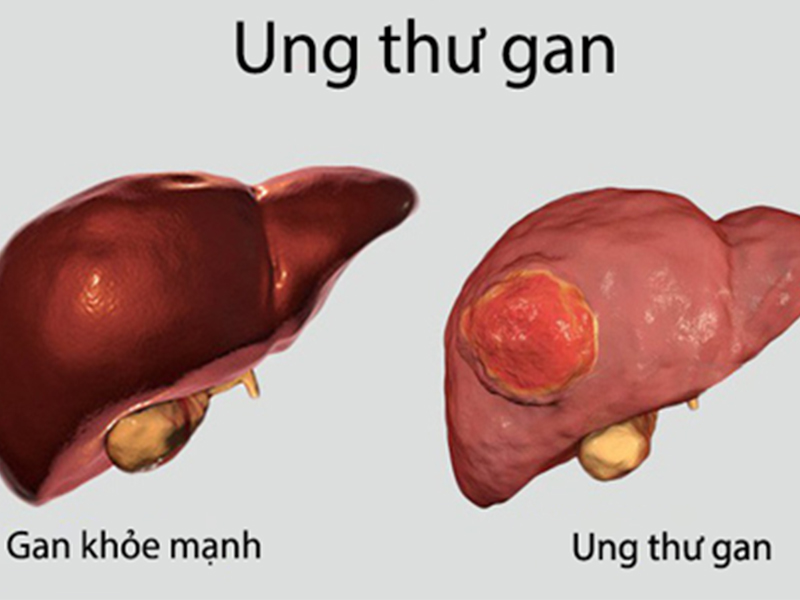 Ung thư gan: các nguyên nhân và khả năng lây qua đường ăn uống