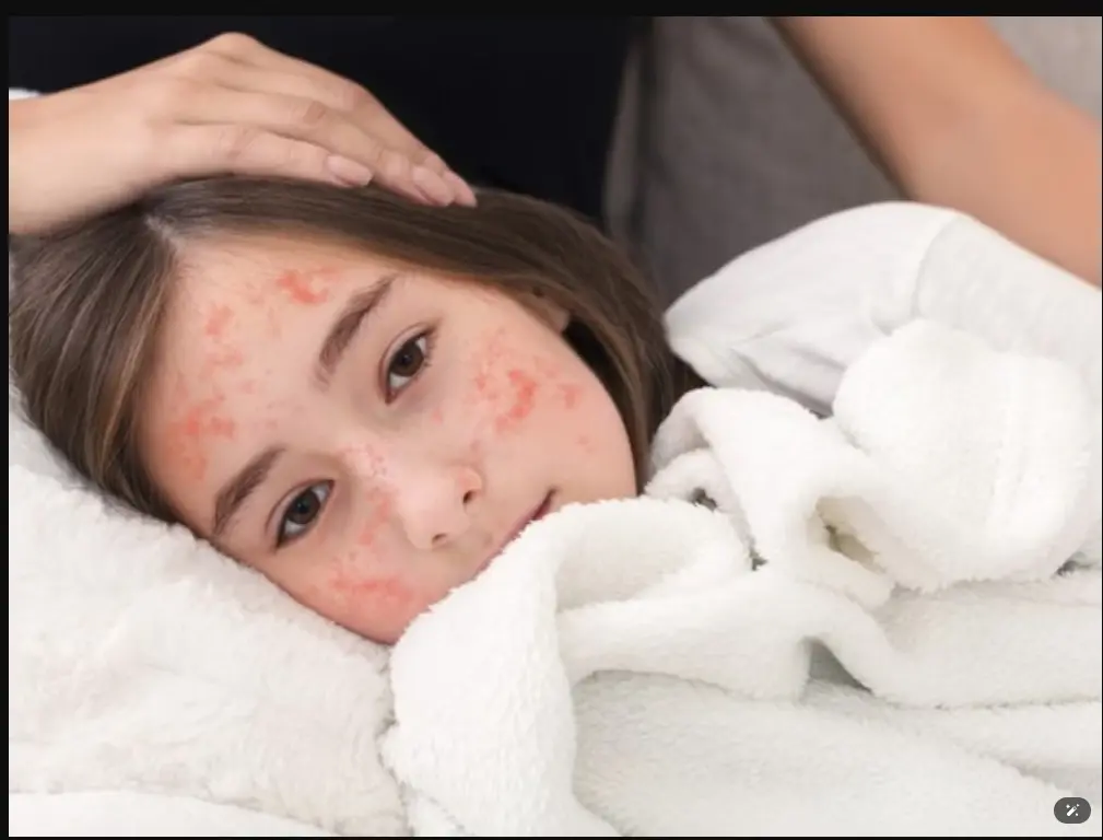 Cách chăm sóc người mắc bệnh sởi tại nhà