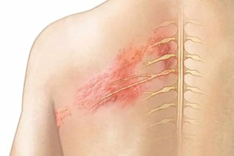 Bệnh zona thần kinh kiêng nước không ?