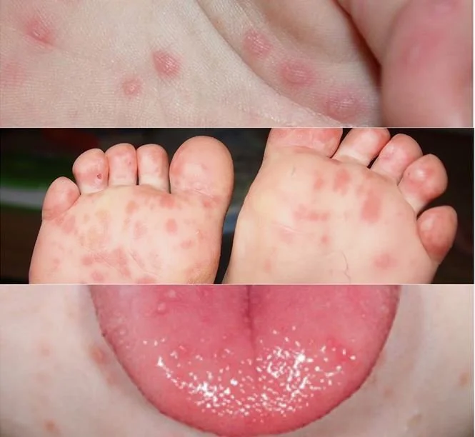 Số ca mắc tay chân miệng ở Hà Nội tăng mạnh