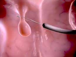 Polyp dạ dày là gì? Dấu hiệu nhận biết và cách điều trị