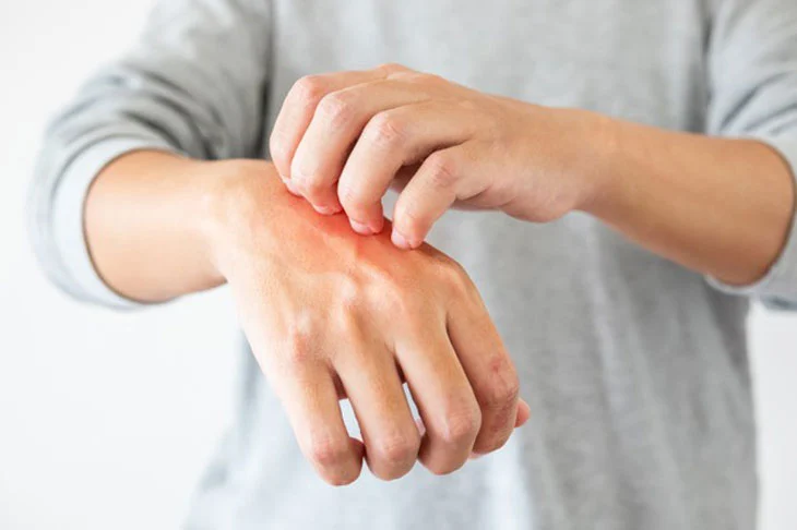 Viêm da dị ứng do thời tiết: bệnh ngoài da phổ biến nhiều người mắc phải