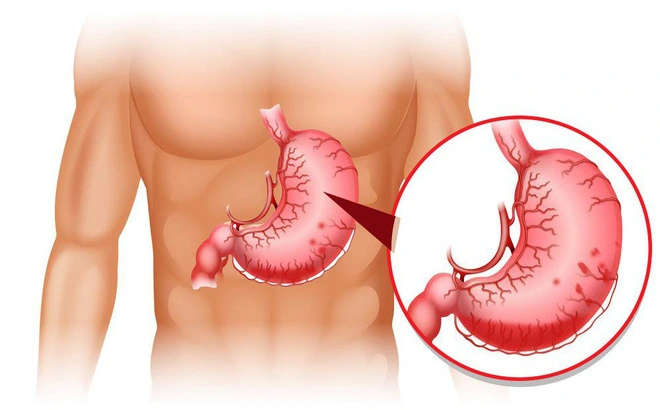 Điểm mặt các dấu hiệu bất thường về đau dạ dày cần tới bác sĩ