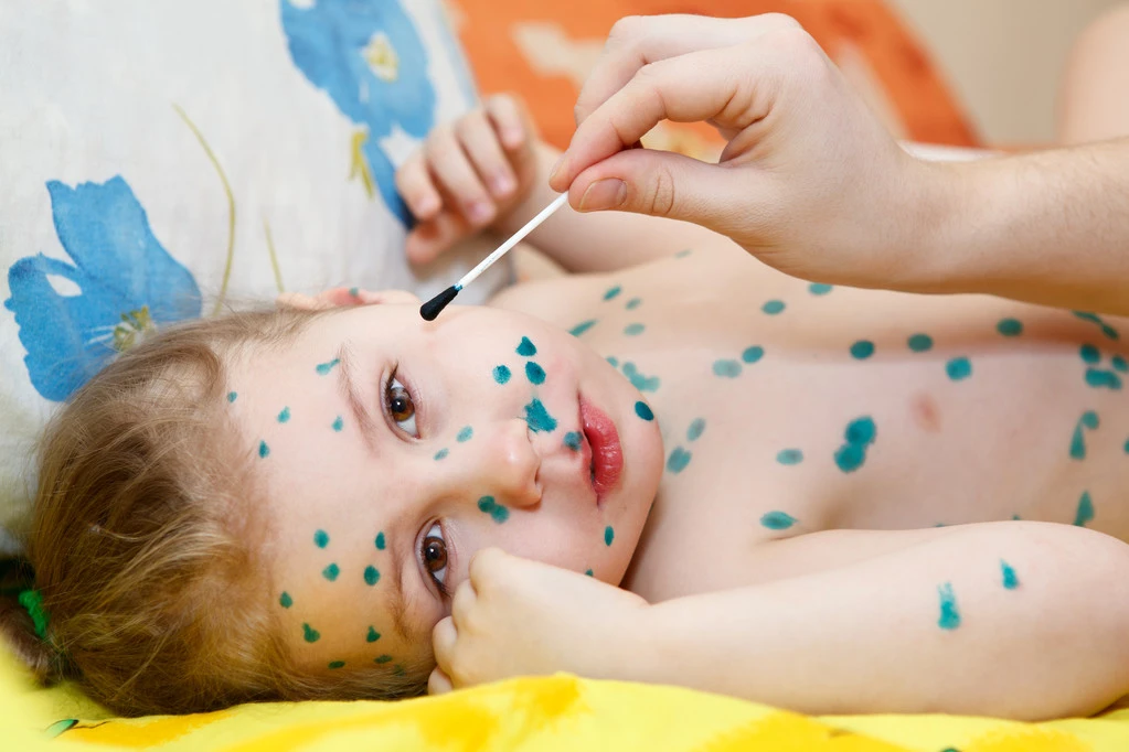 Thuốc nào dùng điều trị thuỷ đậu?