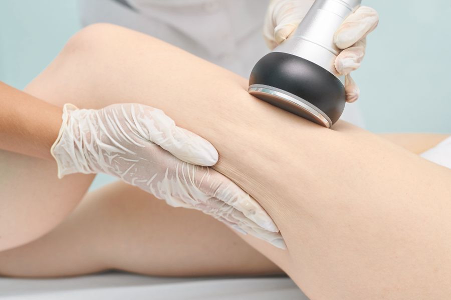 Các cách khắc phục rạn da hiệu quả