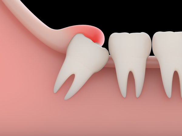 Cấu tạo và chức năng của răng khôn