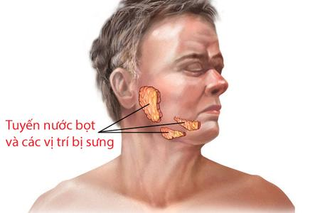 Phòng ngừa bệnh quai bị trong nam giới