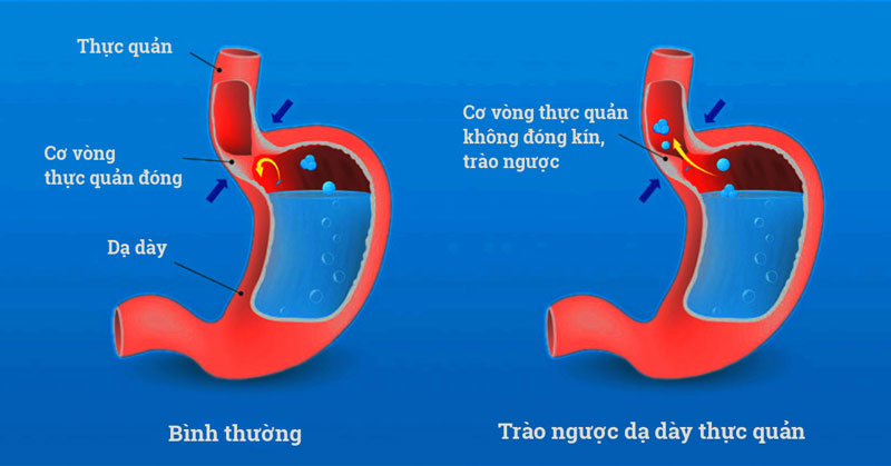 Biểu hiện trào ngược dạ dày là gì? Cách nhận biết và điều trị kịp thời